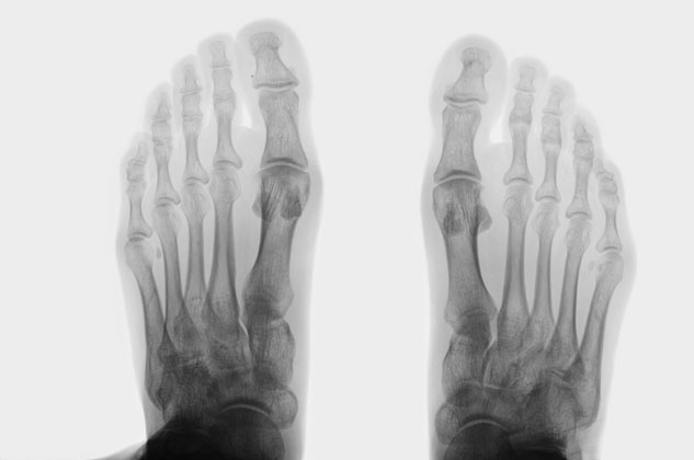 x-ray of feet