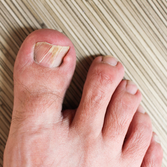 close up of a broken toenail